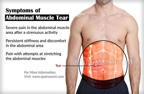 Abdominal Muscle Tearcausessymptomstreatmentrecoveryexercise
