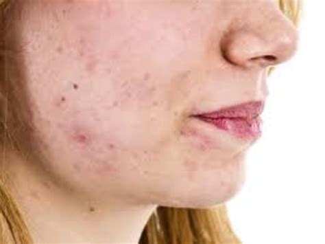 What Is Folliculitis By Dr Radhika A Md Lybrate