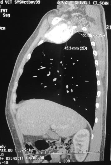 Ct Chest Saggital View Showing Dimensions Of The Tumor Download