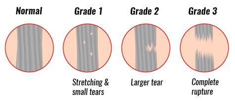 The medial collateral ligament (mcl) is the most commonly injured ligament of the knee. Medial Collateral Ligament (MCL) Injuries - My Family Physio