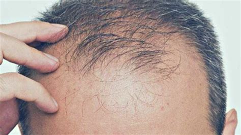 Alopecia Androg Nica Qu Es Y C Mo Puede Tratarse Con La Gente Noticias