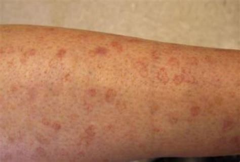 We did not find results for: Brown Spots on Legs, Lower Legs, Get Rid of Little Light ...