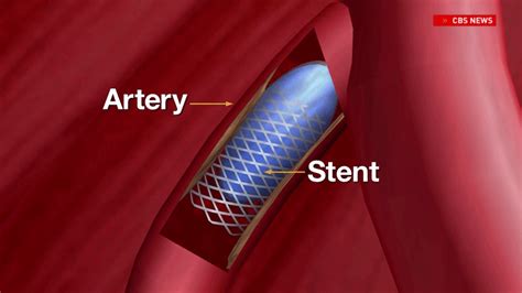 Heart Month Local Cardiologists Explain Stents And How They Are Used