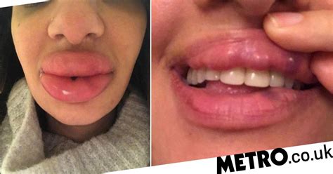 botched lip fillers left woman with rock hard blue lumps on her mouth metro news