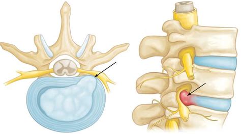 Pinched Nerves Dont Have To Be A Pain In Your Neck Physio Performance