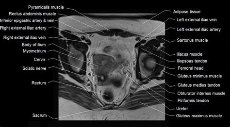 Mri Female Pelvis Anatomy Axial Image 17 Sartorius Muscle Pelvis