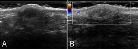 Sebaceous Cyst Vs Lipoma Ultrasound