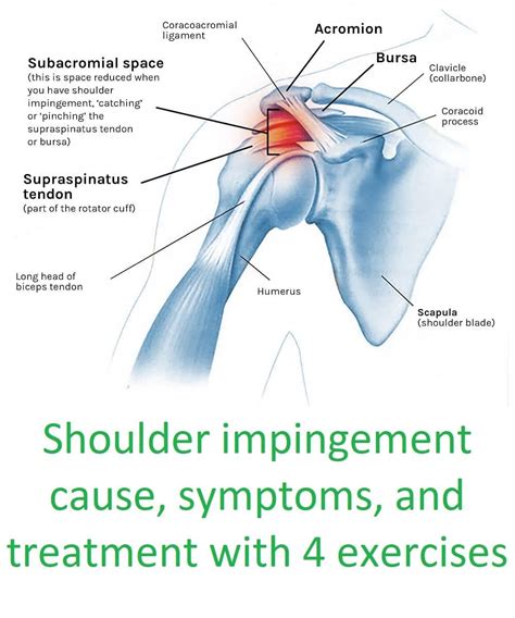Shoulder Impingement Cause And Treatment With 4 Exercises