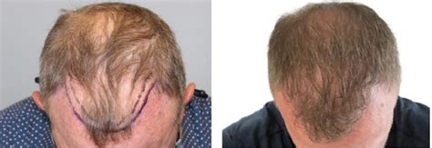 Artas Before And After Gallery Robotic Fue Hair Transplant
