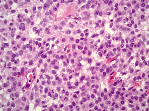 Pathology Outlines Granulosa Cell Tumor Adult