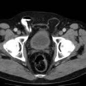 Symptoms of direct and indirect hernia both direct and indirect hernia can trigger a bulge on either side of the groin, depending on how big the hernia is. Direct inguinal hernia | Radiology Reference Article ...
