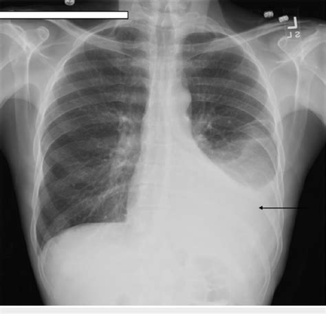 A case report yeoungjee cho, vincent d'intini, dwarakanathan ranganathan j med case reports. Chest X-ray shows large left side pleural effusion (arrow ...