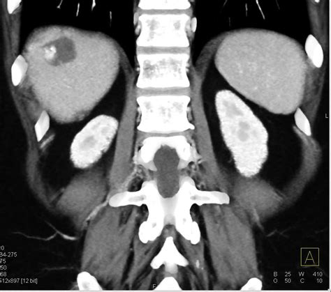 Hemangiomas And Focal Nodular Hyperplasia Fnh Liver Case Studies