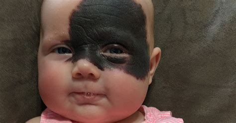 Hull Dads Shock After Daughter Is Born With Black Batman Birthmark