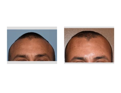 Plastic Surgery Case Study Anterior Sagittal Ridge Skull Reduction