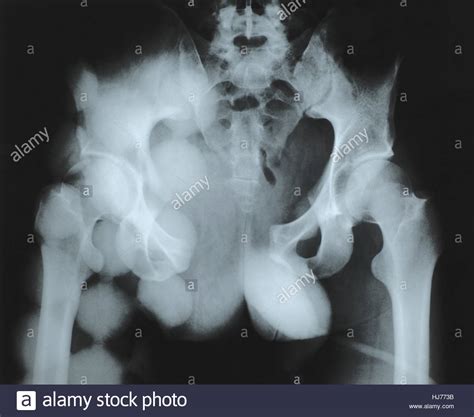 Coccyx Fracture High Resolution Stock Photography And Images Alamy