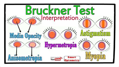 Interpretation Of Bruckner Test Youtube