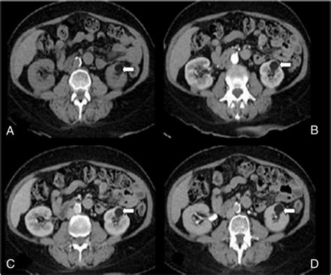Multiphase Renal Ct In The Evaluation Of Renal Masses Is The