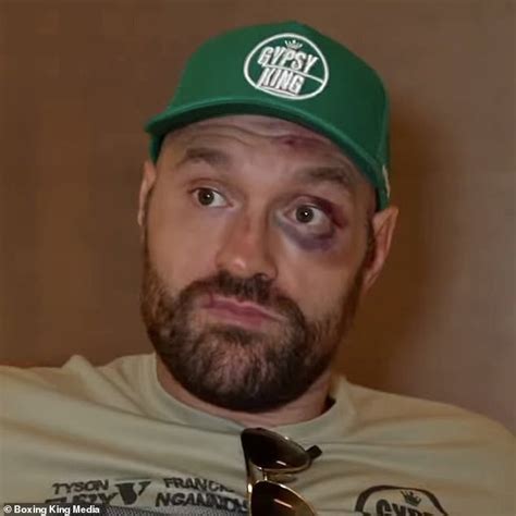 Tyson Fury Shows Off Black Eye And Bruised Face Following His Controversial Victory Over Francis