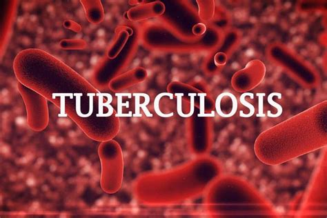 Tuberculosis Kills 18 People Per Hour In Nigeria Earth Chronicles News