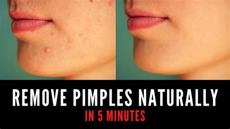 How To Remove Pimples Naturally At Home Remove Pimples In Minutes