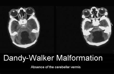 Malformation De Dandy Walker Syndrome De Dandy Walker