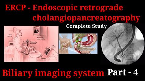 Ercp Procedure Endoscopic Retrograde Cholangiopancreatography