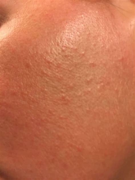 Re Small Rash Like Bumps All Over Face Page 2 Beauty Insider Community