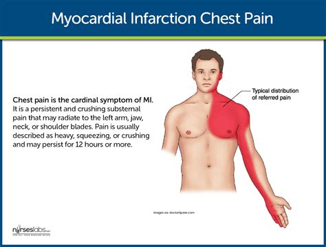 Myocardial Infarction Symptoms