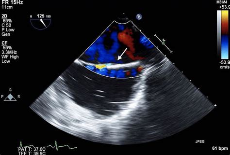 A Pfo As Seen On Transesophageal Echocardiography Tee With Color