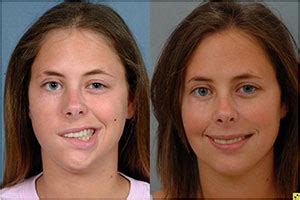 Do you want to learn about bell's palsy? مرحبًا في جونز هوبكنز ميديسن باللغة العربية