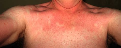 Rash 22 Common Skin Rashes Pictures Causes And Treatment Health