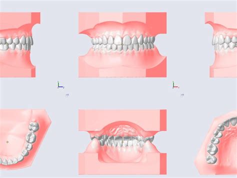 Wenn ein Zahn gezogen werden muss Orthodentix Kieferorthopäde