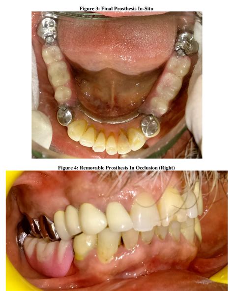 Figure 4 From Management Of Long Partially Edentulous Space In