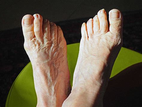Osteoarthritis Of The Big Toe Symptoms Causes And More