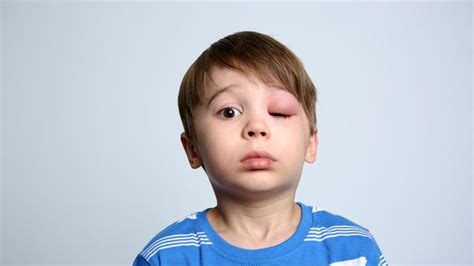 12 Penyebab Mata Bengkak Pada Anak Dan Cara Mengatasinya