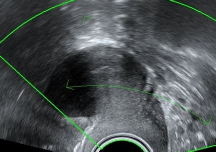 Unicornuate Uterus D Ultrasound Radiology Case Radiopaedia Org
