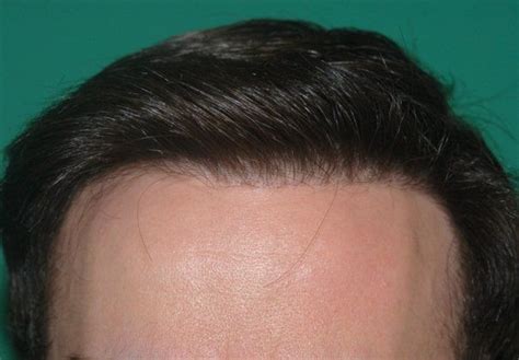 Donor hair can be harvested in two different ways: 2345 Graft Frontal Hairline Restoration - Hair Loss ...