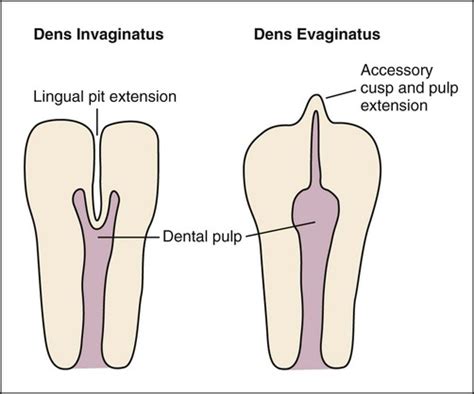 16: Abnormalities of Teeth | Pocket Dentistry