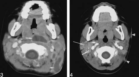 Nontuberculous Mycobacterial Infection Of The Head And Neck In