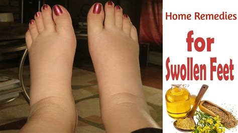 6 Natural Soothing Home Remedies For Swollen Feet And Ankles Youtube