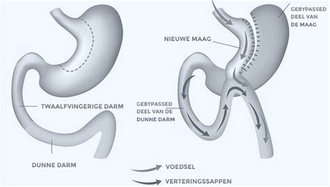 Mini Gastric Bypass Centrum Voor Mini Gastric Bypass