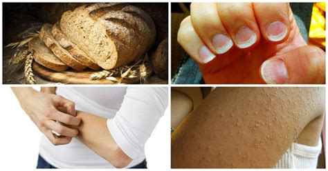 These Signs And Symptoms Shows That You Have A Gluten Allergy And You