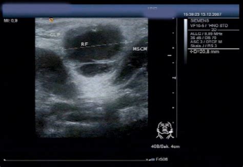 Ultrasound Scan Of An Atypical Mycobacterial Infection In The Inferior