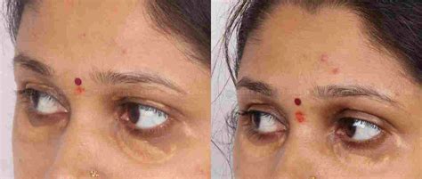 Xanthelasma Before After Results