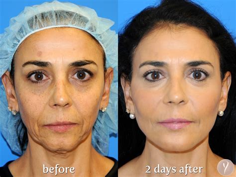 Y Lift The Non Surgical Facelift Transform Yourself Facial