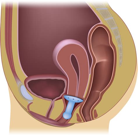 Nonsurgical Treatment Options For Women With Pelvic Organ Prolapse Nursing For Women S Health