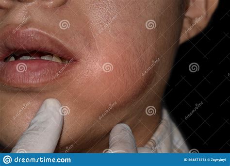 Swelling At The Cheek Of Asian Man Abscess Formation Stock Photo