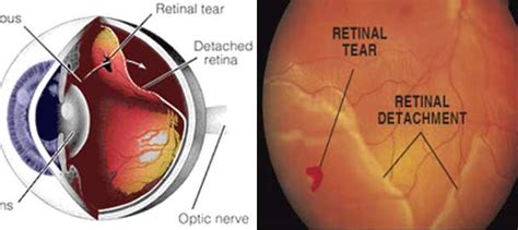 Detached Retina Can It Be Prevented
