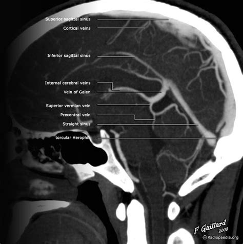 Confluence Of Sinuses Radiology Reference Article